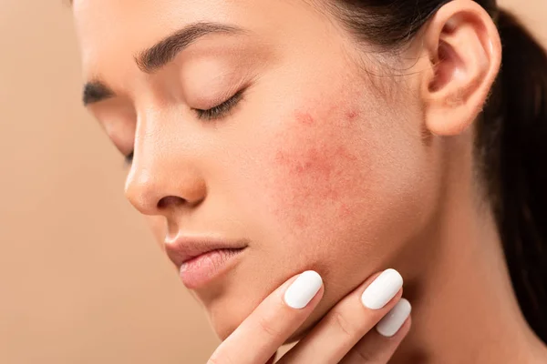 How to Prevent Acne: 10 Tips to Reduce Pimples