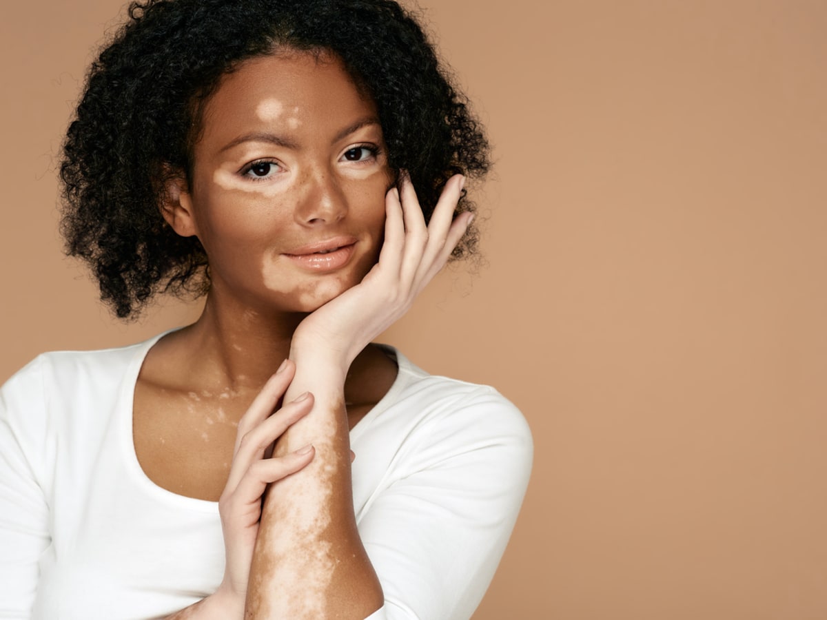 Best Creams for Vitiligo in India